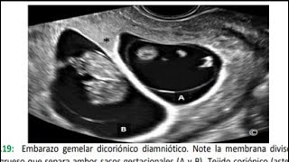 EMBARAZOS GEMELARES DATOS ECOGRAFICOS PRINCIPALES [upl. by Fonseca641]