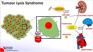 Tumour Lysis Syndrome [upl. by Eissat]