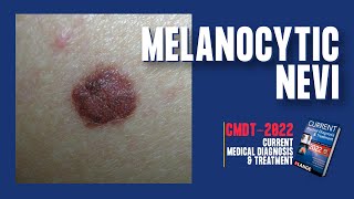 Melanocytic Nevi Normal Moles  PIGMENTED LESIONS  CMDT 2022 [upl. by Denae475]