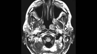 Chronic Lymphocytic Leukemia of the Maxillofacial Region [upl. by Gemperle]