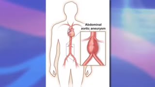 Risks and Benefits of Endovascular Abdominal Aortic Aneurysm Repair EVAR [upl. by Yael961]