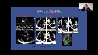 Ecocardiografia en la predicción de embolismo y recurrencia de la FA  Carlos Javier Ramirez [upl. by Acinomahs494]