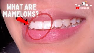 What are mamelons do you need to fix them Tooth Time Family Dentistry New Braunfels [upl. by Ecnatsnok]