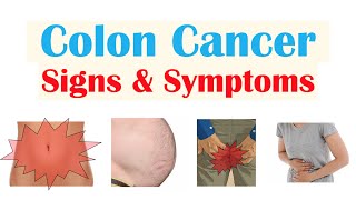 Colon Cancer CRC Signs amp Symptoms amp Why They Occur [upl. by Ethban]