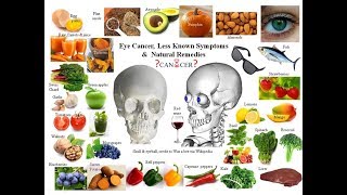 Eye Cancer  Less Known Signs and Natural Cures [upl. by Morganica]