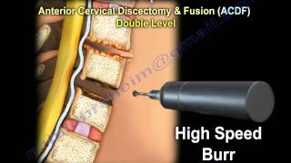 Cervical Spine Decompression And Fusion   Everything You Need To Know  Dr Nabil Ebraheim [upl. by Harbed]