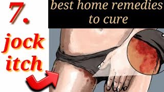 How to cure jock itch fast naturaly  7 best home treatment for jock itch by natural remediestips [upl. by Haig]