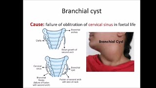 Branchial cyst [upl. by Turne]