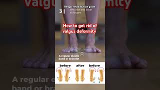 🔥💯✅Worried about foot deformityValgus deformity correctionytshortsrehabilitationfootexerciseyt [upl. by Elwyn]