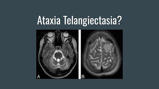 What is Ataxia Telangiectasia AT [upl. by Blasius]