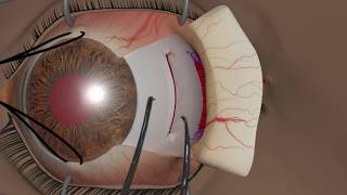 Strabismus surgery Recession [upl. by Rodrique]