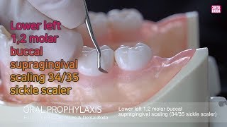 Lower left 12 molar buccalsupragingival scaling 3435 sickle scaler [upl. by Arym]