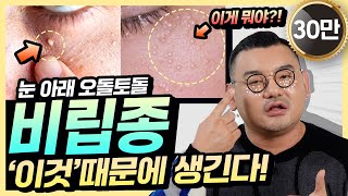 눈밑에 비립종 왜 생길까 피부과의사가 알려주는 비립종 똑 없애는 예방법 4가지 깨끗한 눈가만들기 [upl. by Olathe]