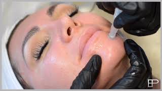 Meso Skin Rejuvenation Video skin needling [upl. by Andres284]