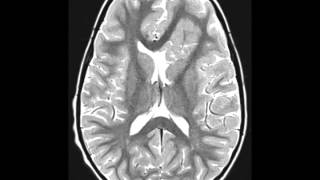 Cortical Dysplasia [upl. by Einallem727]