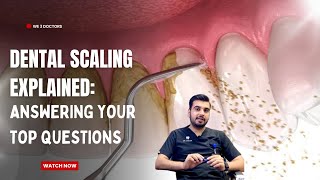 Answering your top questions about Dental Scaling  Teeth whitening  Oral Hygiene [upl. by Danyluk]