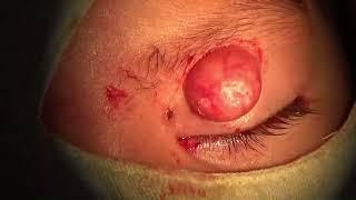 Molluscum Contagiosum Lesions Excision [upl. by Laverna639]