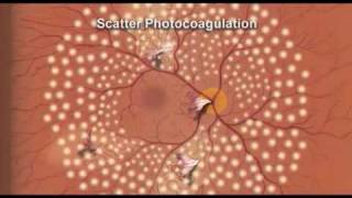 Pan Retinal Photocoagulation Diabetic Retinopathy [upl. by Ibed]