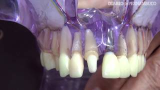 Para substituir um dente o pivô pode ser a solução [upl. by Assirhc]