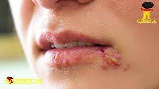 Sieben Heilpflanzen gegen Herpes [upl. by Alimrahs]