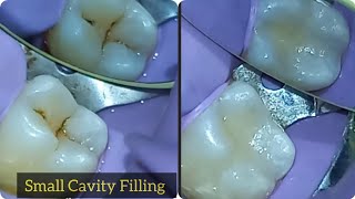 Class 1 Cavity Composite Restoration  Tooth Decay Removal Procedure [upl. by Lada932]