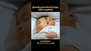 Girl born with 2 faces gets a magical power  இரண்டு முகங்களோடு பிறந்த அதிசய குழந்தை  Infogle [upl. by Dunn156]