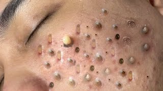 ACNE TREATMENT VU QUYNH MI Blackheads Removal Popping [upl. by Ecylla646]