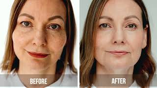 LACTIC ACID AND PLACENTA PEEL FOR EVEN SKIN TONE  FORLLED [upl. by Semele]