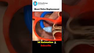 Heart Valve Replacement Procedure 👨‍⚕️ [upl. by Varuag]