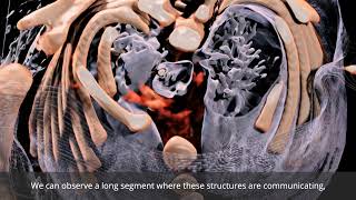 Anatomage Table Patient Case 302 Laryngotracheal Esophageal Cleft [upl. by Notsirb]