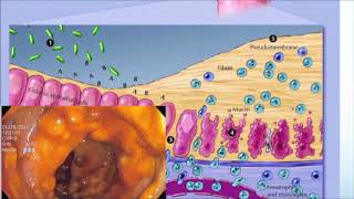 عدوى الكلوستريديوم العسير  Clostridioides difficile infection [upl. by Homans]