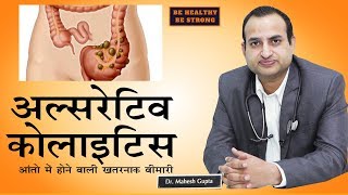 Ulcerative Colitis  अल्सरेटिव कोलाइटिसआंतो की गंभीर बीमारी  Dr Mahesh Gupta [upl. by Akerdnahs]