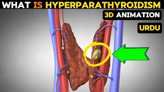 What is hyperparathyroidism causessymptoms and treatment [upl. by Irej70]