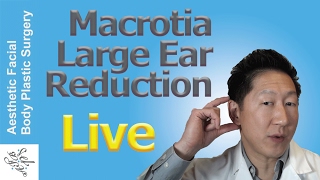 LARGE EAR MACROTIA REDUCTION OTOPLASTY SURGERY Patient True Story Live Surgery Before amp Afters [upl. by Anadroj]