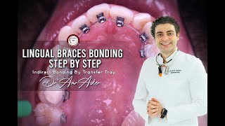 Lingual braces bonding step by step indirect bonding by transfer tray by Dr Amr Asker invisible [upl. by Belldas]