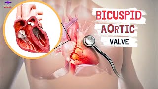 Bicuspid Aortic Valve  cardiology [upl. by Aerdnna]