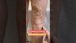 🏩escleroterapia venasvaricosas infiltraciondevarices varicosevein arañasvenenosas [upl. by Ilamad618]