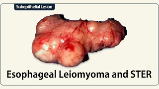 Esophageal Leiomyoma and STER [upl. by Rona614]