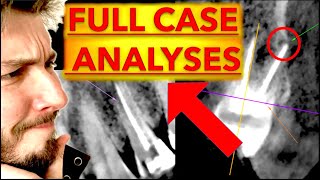 Advanced Dental Radiographs Interpretation CARIES amp Radiolucent LESIONS  OPG Xray 3D CBCT reading [upl. by Atirys]