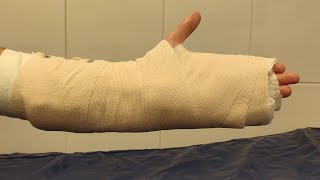 How to apply a hand cast  Using plaster of paris bandage  Ulnar gutter splint [upl. by Derron328]