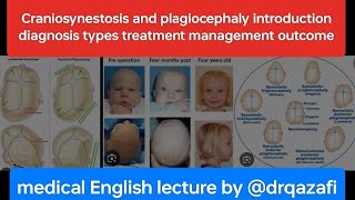 Craniosynestosis and plagiocephaly introduction diagnosis types treatment management outcome [upl. by Birkner]