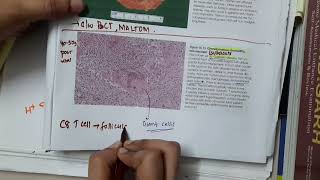 granulomatous thyroiditis  Pathology [upl. by Adgam362]