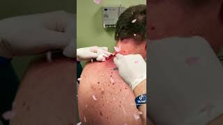 Las Vegas Dermatology Cyst Follow up video 🎥 with incision and drainage procedure 💉 🔪 [upl. by Apfel62]