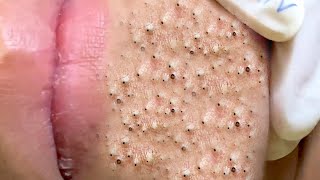 Big Cystic Acne Blackheads Extraction Blackheads amp Milia Whiteheads Removal Pimple Popping  6553 [upl. by Wanyen]