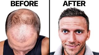 AWFUL Hair Transplant 4 Month RECOVERY  Hair Surgeon Reacts [upl. by Kreager]