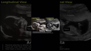 Anterior Placenta Position Ultrasound  Fetal USG  Pregnancy Sonography  Dr Sams Imaging shorts [upl. by Marwin]