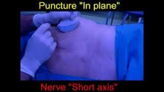 Ultrasound Sciatic Nerve Blockade Casals Approach part1 [upl. by Cooke829]