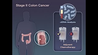 ctDNAGuided Therapy in Stage II Colon Cancer  NEJM [upl. by Carmita]