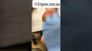 Cracked heels callus hard skin removal by podiatrist [upl. by Yrohcaz539]