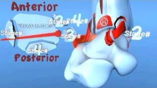 Lauge Hansen PER Pronation External Rotation Eversion Ankle Fracture [upl. by Bierman]